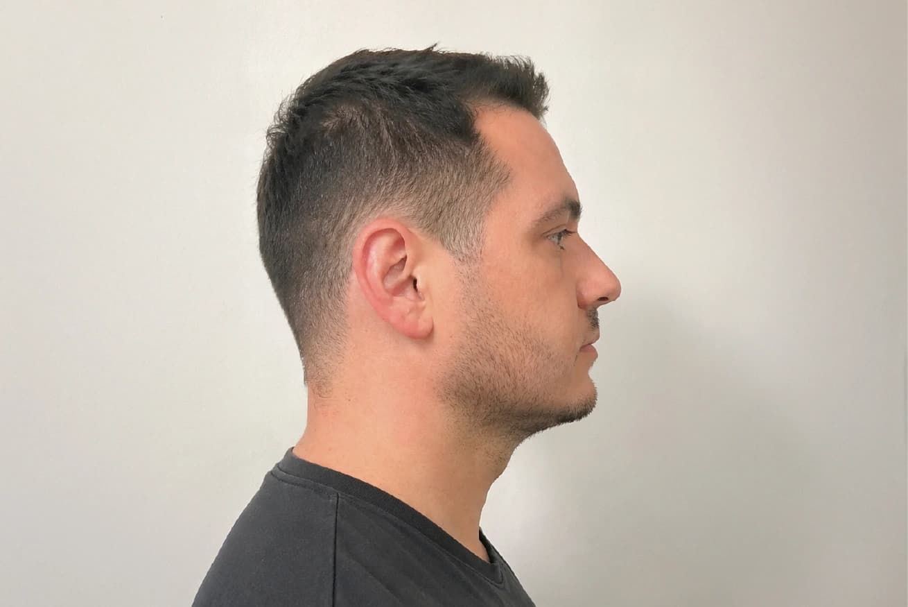 Double Chin Reduction after result