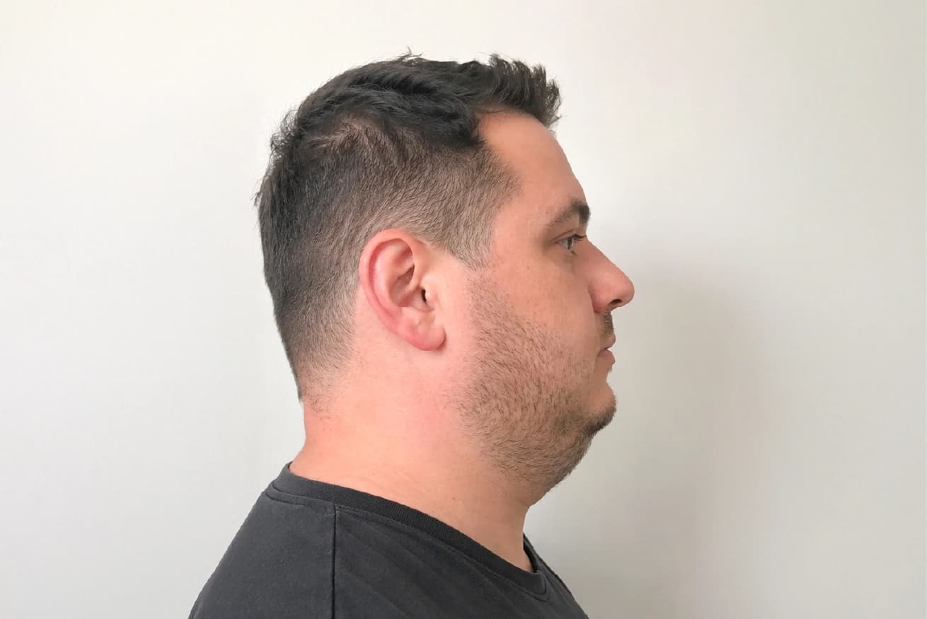 Double Chin Reduction before result