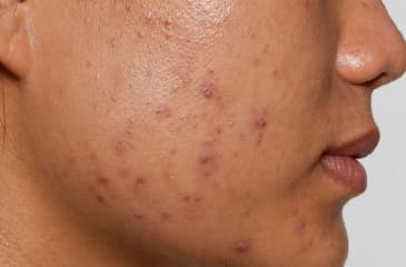 Post-Acne Pigmentation