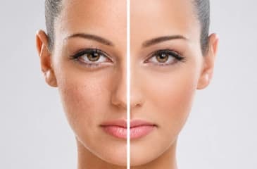 Skin Brightening & Rejuvenation