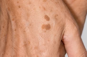 Sun Damage & Age Spots