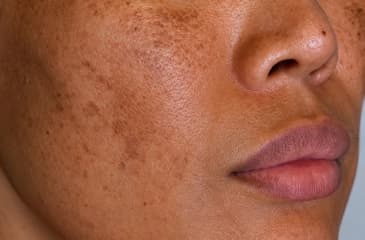 Melasma