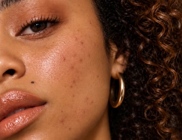 Benefits and long-term value of acne scar treatment