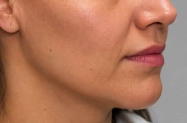 Jawline & Chin
