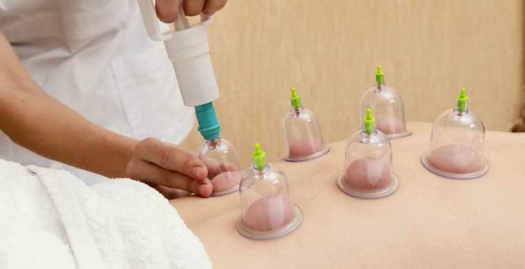 Cupping at Amara
