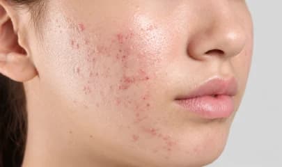 Management of Acne & Pigmentation
