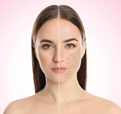 Acne & Scar Treatment