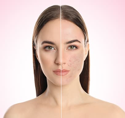Acne & Scar Treatment