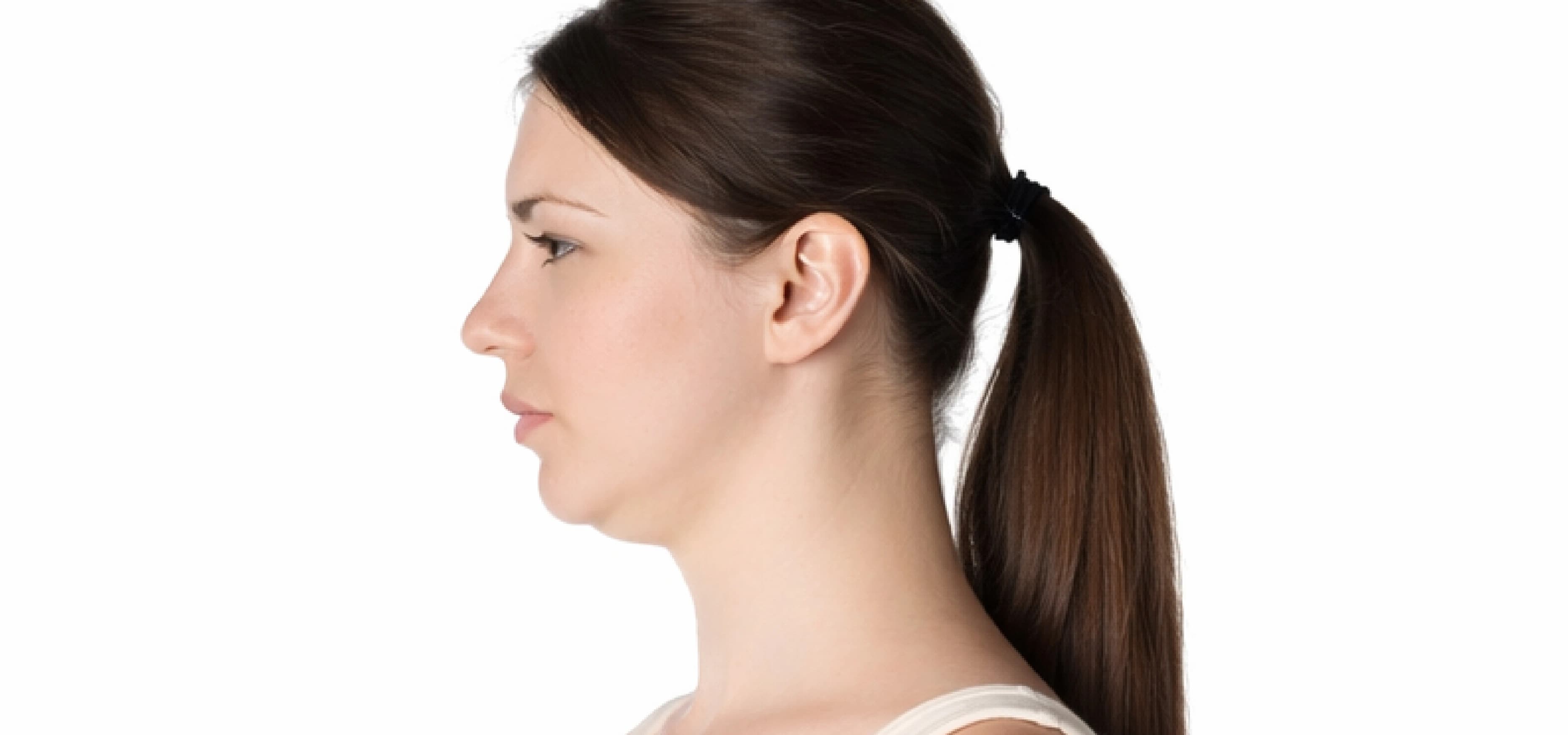 Double Chin Reduction before result