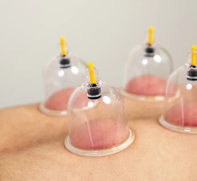 Dry Cupping Therapy