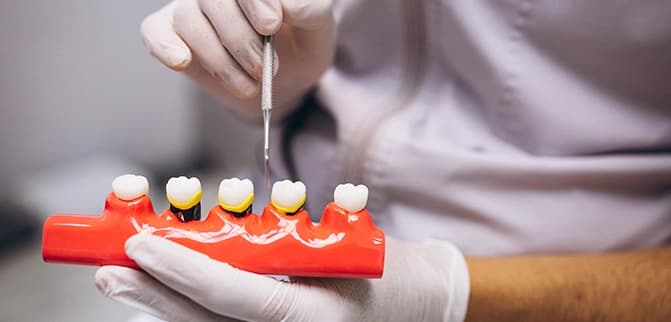 Dental Implants