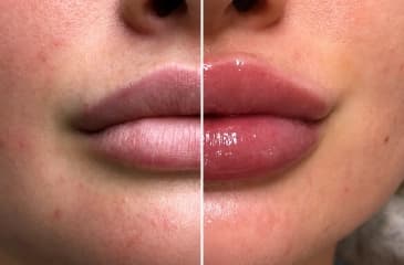 Hydration Treatment for Lips