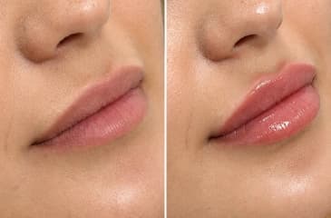 Natural Lip Enhancement