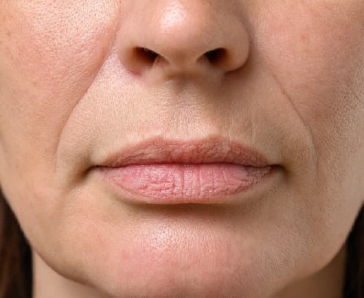 Who might not be suitable for lip fillers in Dubai