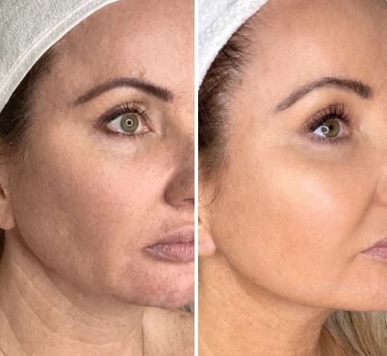 Morpheus Pro Treatment