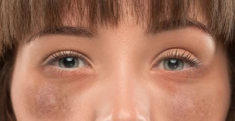 Under-Eye Area