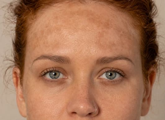 Pigmentation treatment consultation in Dubai