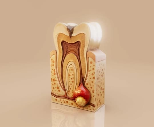Root Canal Symptoms