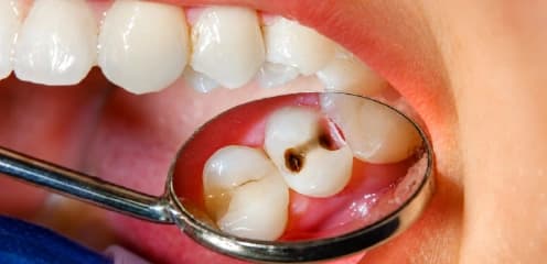 Treating Tooth Decay