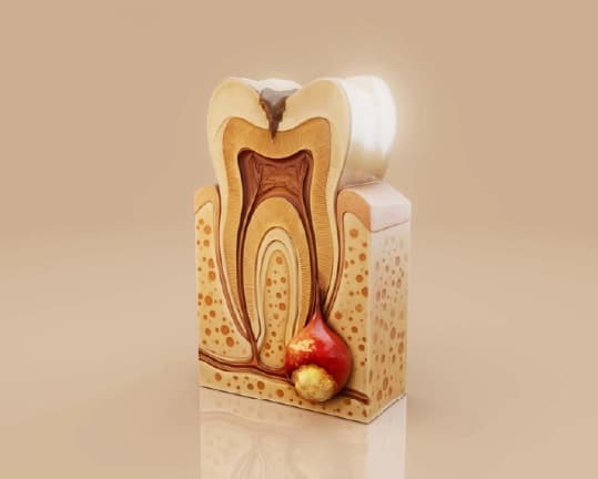 Root Canal Symptoms