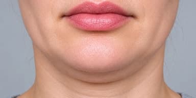 Cheeks RRS skin boosters in Dubai