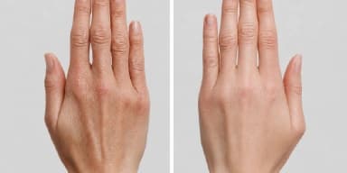 Hands RRS skin boosters in Dubai