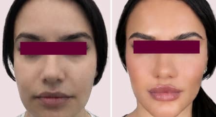 Chin & Pre-Jowl Sulcus