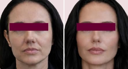 Nasolabial & Marionette