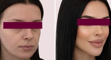 Temples & Upper Face