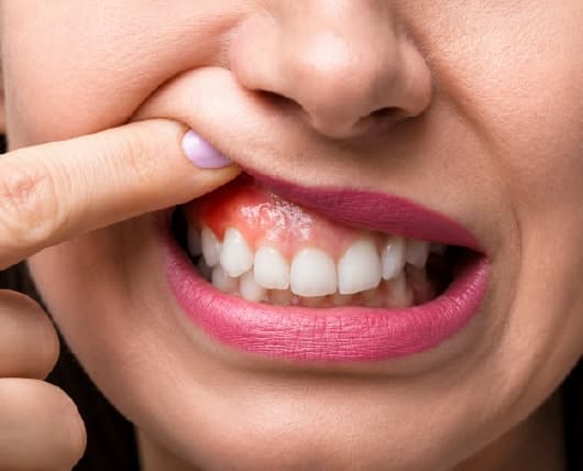 Tooth extraction consultation in Dubai