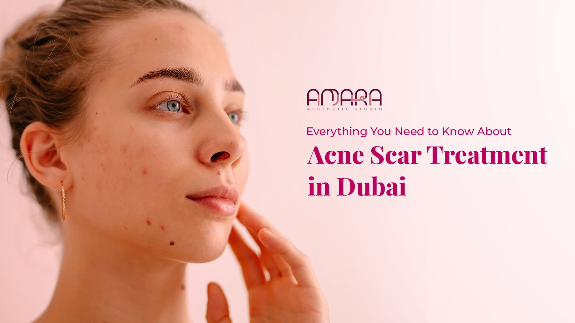 Everything You Need to Know About Acne Scar Treatment in Dubai
