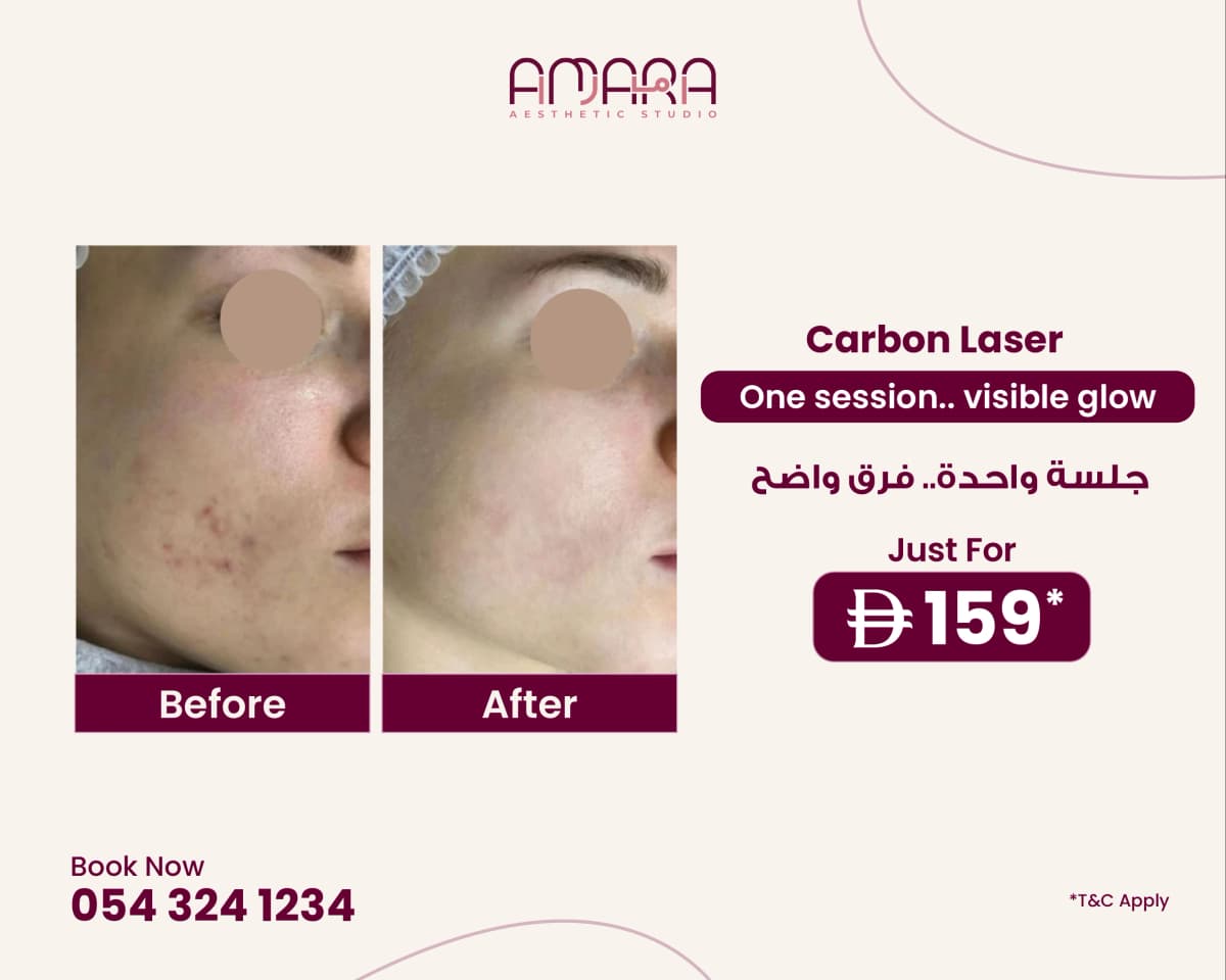 Carbon Laser Treatment – 1 Session