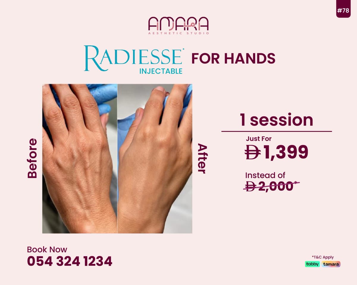Radiesse for Hands – 1 Session