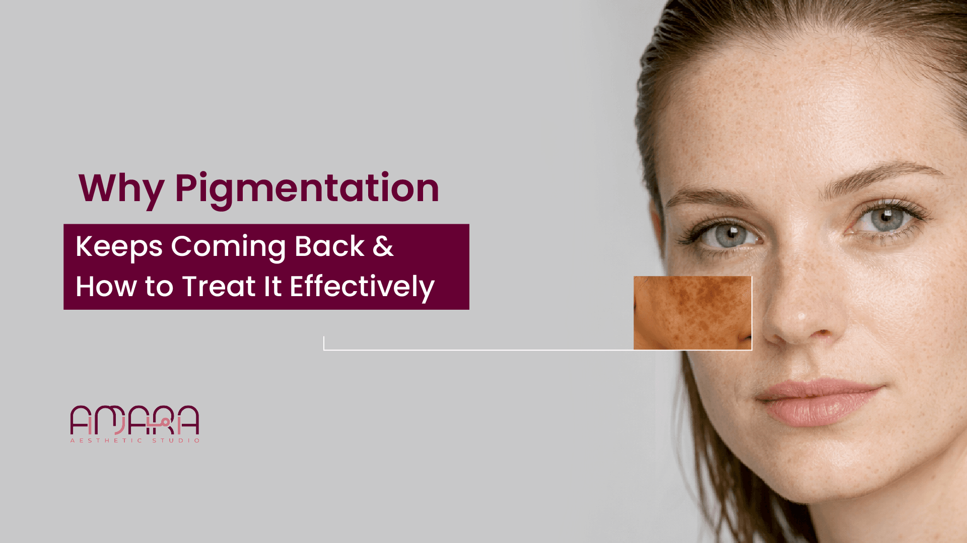 Why Pigmentation Keeps Coming Back and How to Treat It Effectively
