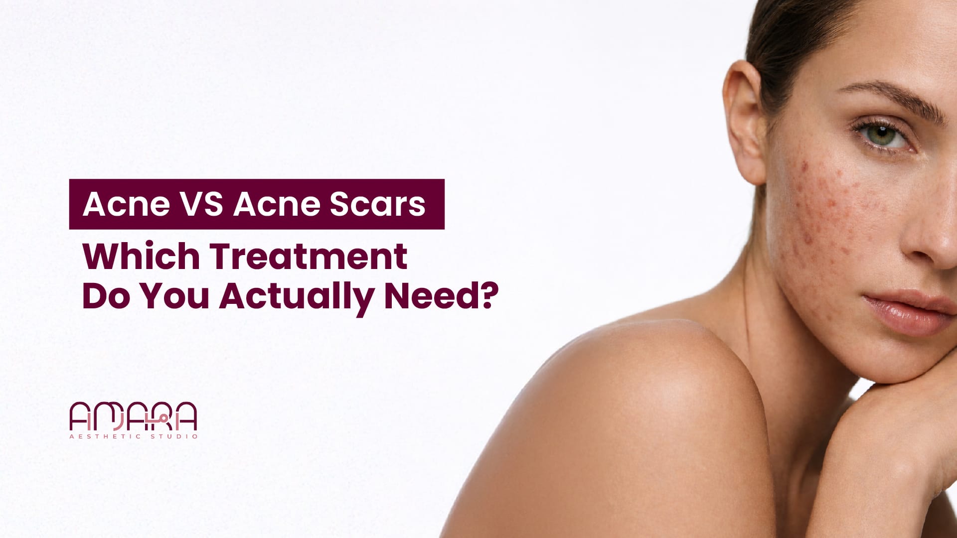 Acne vs Acne Scars? How to Choose the Right Treatment for Your Skin