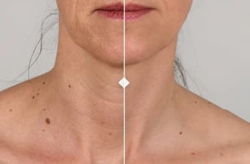 Décolletage
