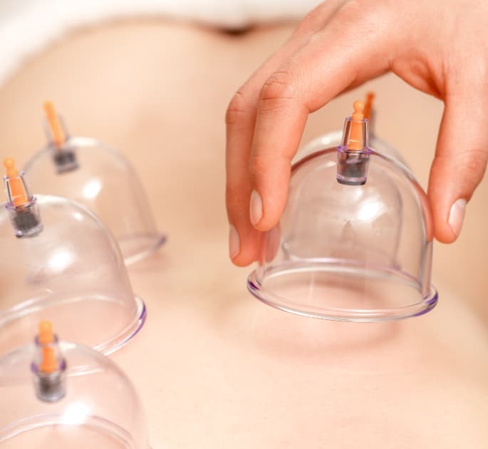 Cupping Therapy