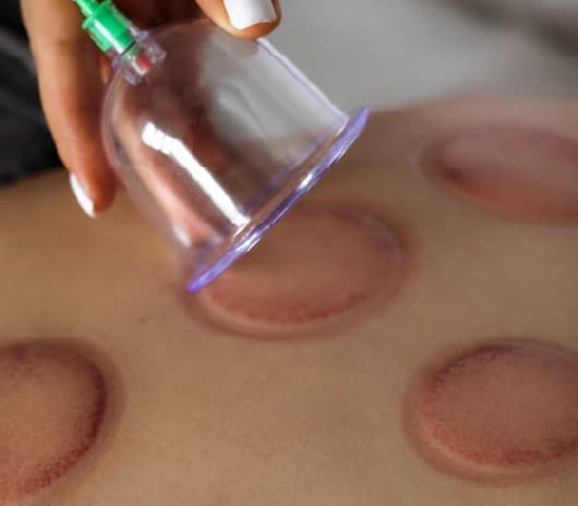 Who can benefit from cupping therapy