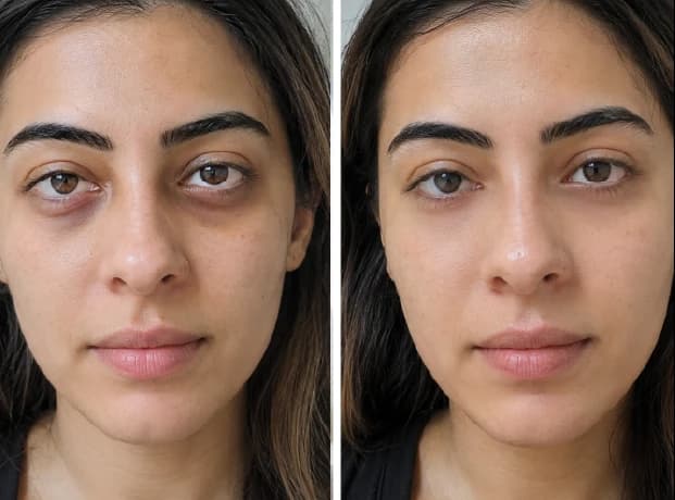 Benefits and long-term value of under-eye treatments