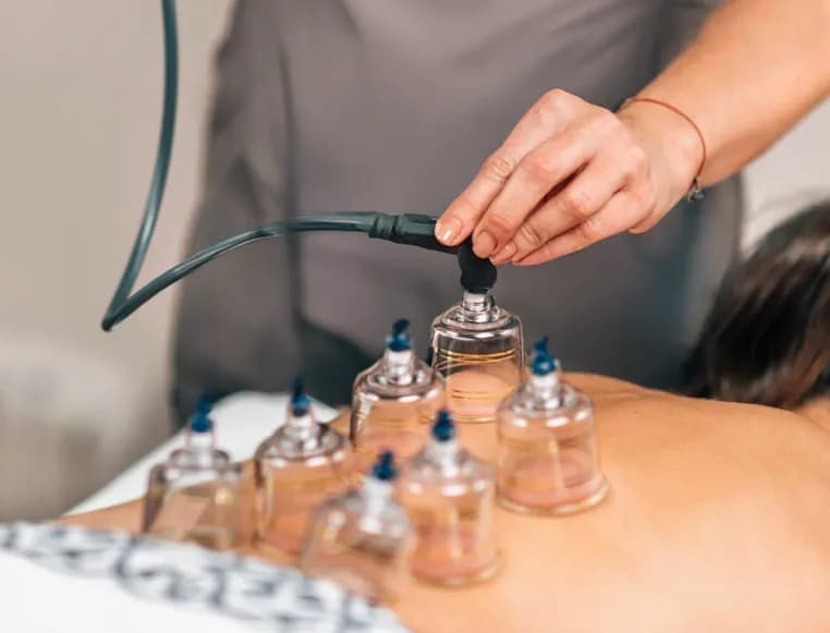 Dry Cupping Benefits