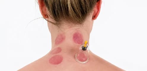 Neck & Upper Body Hijama