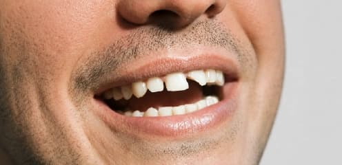 Repairing Damaged Teeth
