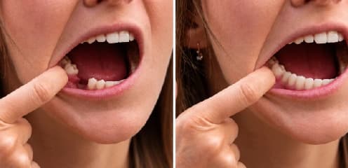 Replacing Missing Teeth
