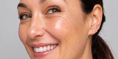 Smile lines RRS skin boosters in Dubai