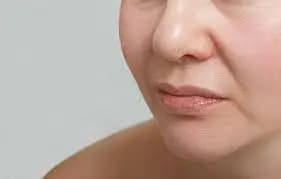Nasolabial Folds