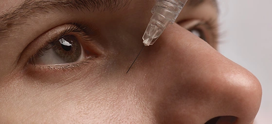 Hollow Under Eyes (Tear Troughs)